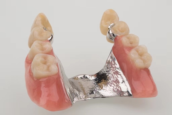 PDF) Distal Extension Removable Partial Denture with