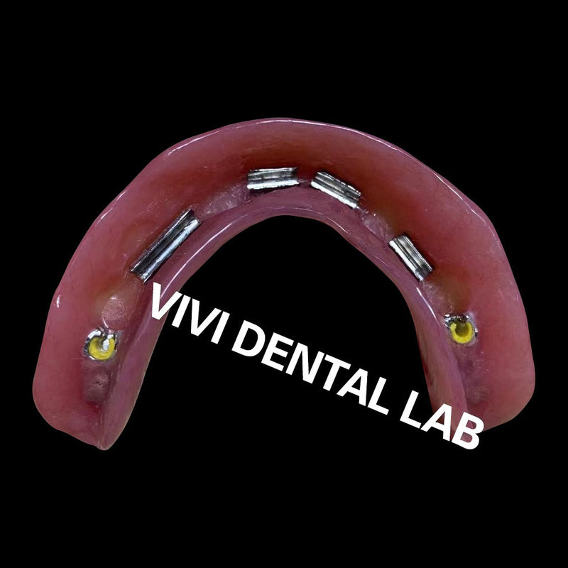 Dental Fixture OT Bar Multiuse Kit Castable Overdenture