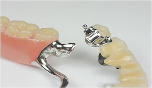 Bolt Attachment changes Partial Denture Prosthodontics - Suginaka “Riegel Bolt Attachment changes Partial Denture Prosthodontics
