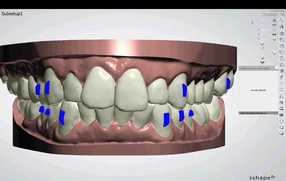 Alignment Correction Professional Teeth Alignment Correction Scheu Clear Correct Aligners