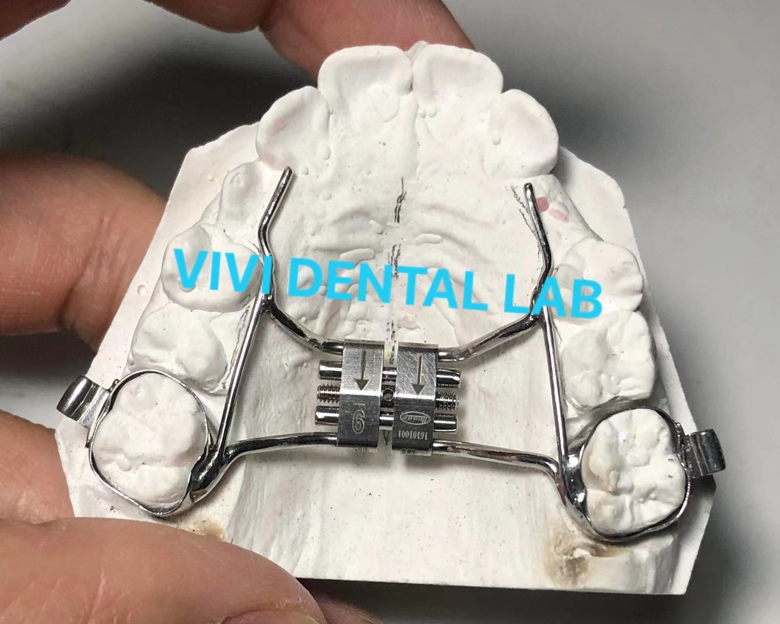 palate-expander-stable-hyrax-palatal-expander-china-dental-lab