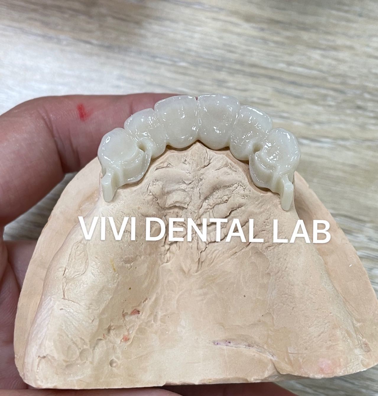 Zirconia Dental Attachment Partial Denture Stable CAD CAM ISO Approved