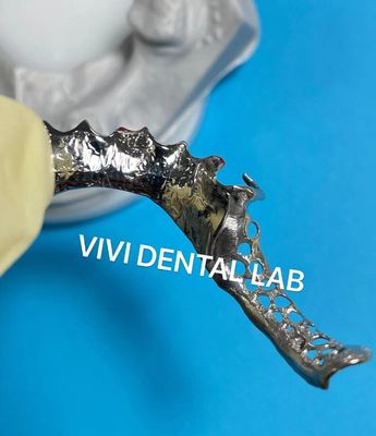 Metal Partial Framework SLM Ni Be free China Dental Lab