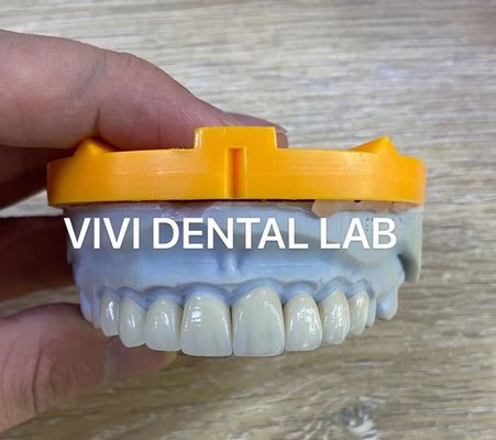 Ivoclar Emax Laminate Veneers Translucent Professional High Level China Dental Lab