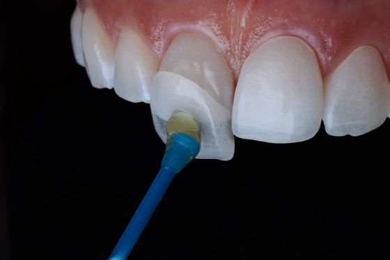 Permanent Composite Emax Zirconia Laminate Veneers Dental Natural Looking