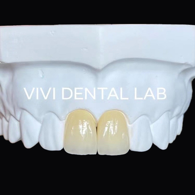 Full Jaw Dental Zirconia Bridge Implant Crown Translucency Esthetic