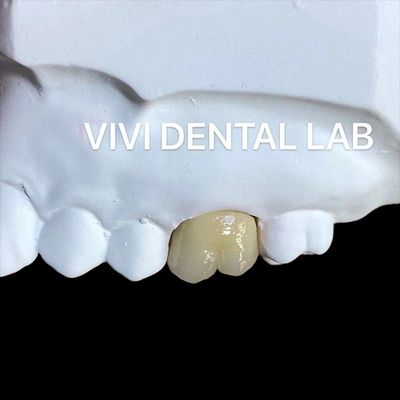 Be Ni Free Metal Porcelain Crowns PFM Crown China Dental Lab