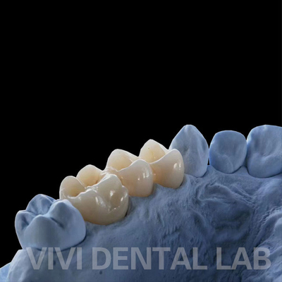 Full Contour Dental Lab Crowns High Translucency Solid Zirconia Crown