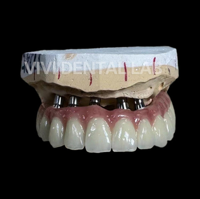 Total Implant PFM Bridge China Dental Lab
