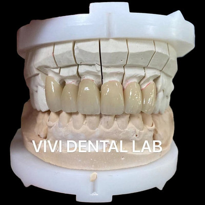 Layered Zriconia Porcelain Fused Metal Crowns In Good Shade