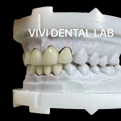 Strong Layered Zirconia Crown And Bridge In Good Esthetics
