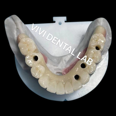 Multi Layer Zirconia Screw Retained Bridge Biocompatible On Metal Structure