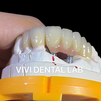 Porcelain Zirconia Dental Implant Bridge Professional High Esthetics