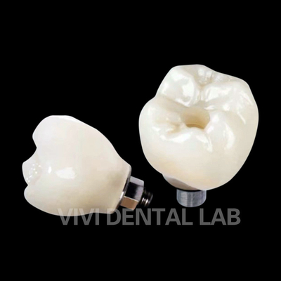Screw Retained Dental Implant Crown PFZ Porcelain Layered Zirconia