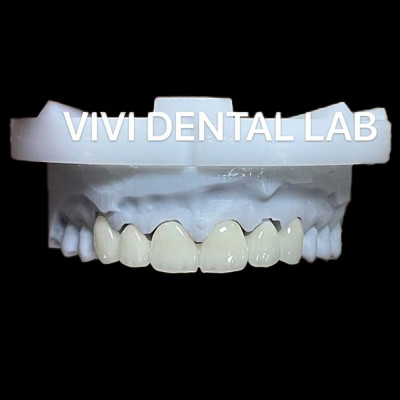 Dental Anterior Zirconia Bridge ISO Certified Fast Turnaround Time