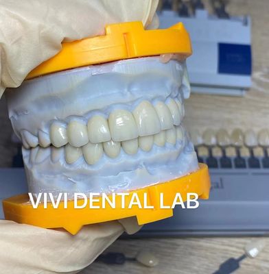 High Esthetic Teeth Emax Laminate Veneers Incisal Translucency China Dental Lab