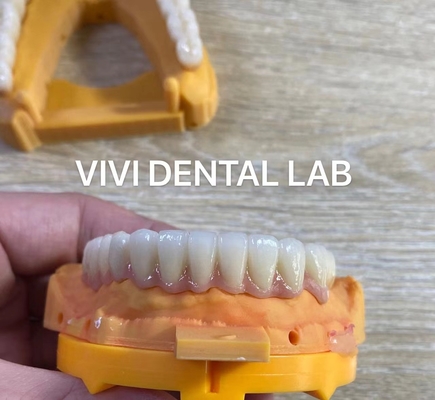 Full Jaw Dental Zirconia Bridge Implant Crown Translucency Esthetic