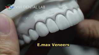 Dental Veneers Laminates