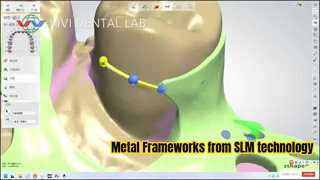 Metal Partial Framework from SLM technology
