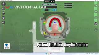 Milled Acrylic Denture Superior Fit Digital