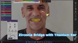 Zirconia Bridge Titanium Bar All on X Solution